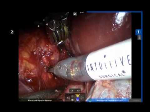 Pheochromocytoma - Robot-Assisted Partial Adrenalectomy In Laparoscopy