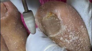 Ep_8745 Ingrown toenail removal 👣 ดูสิ..แทงไม่เข้า 😅 (clip from Thailand)