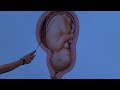 An Overview of a Placental Abruption