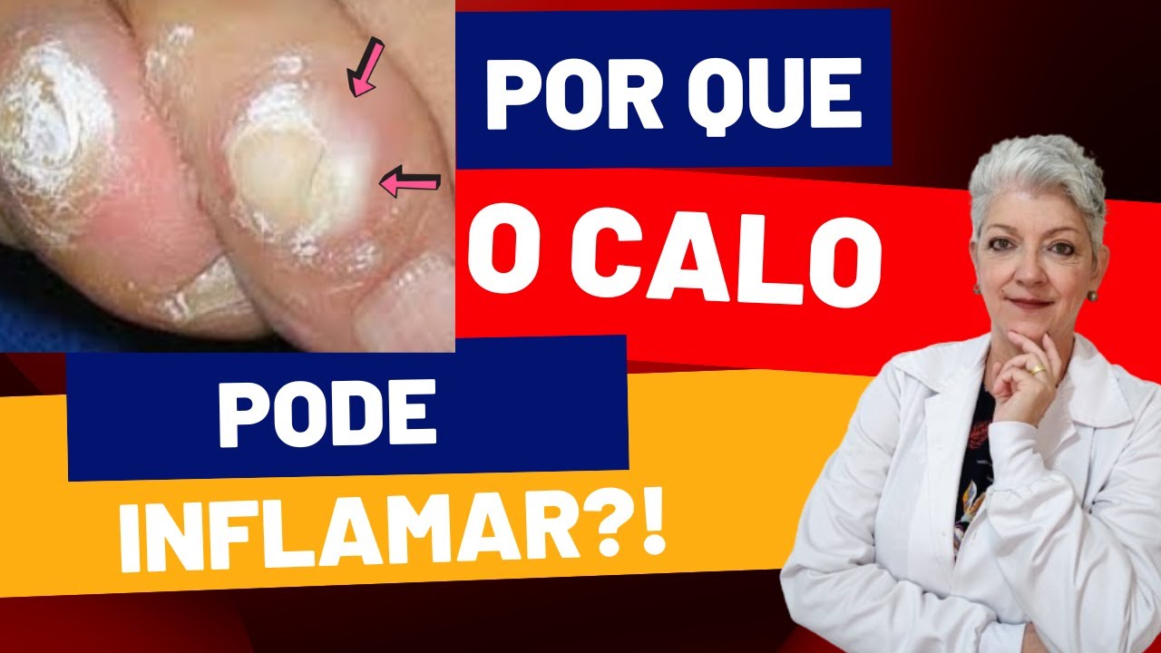 Por que Será que o CALO INFLAMA?