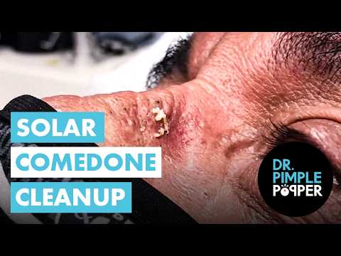 Solar Comedone Cleanup