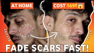 FADE SCARS FAST! 😲 Acne, Chicken Pox, Scars Remove At Home ❌ [Shaikh Lifestyle]