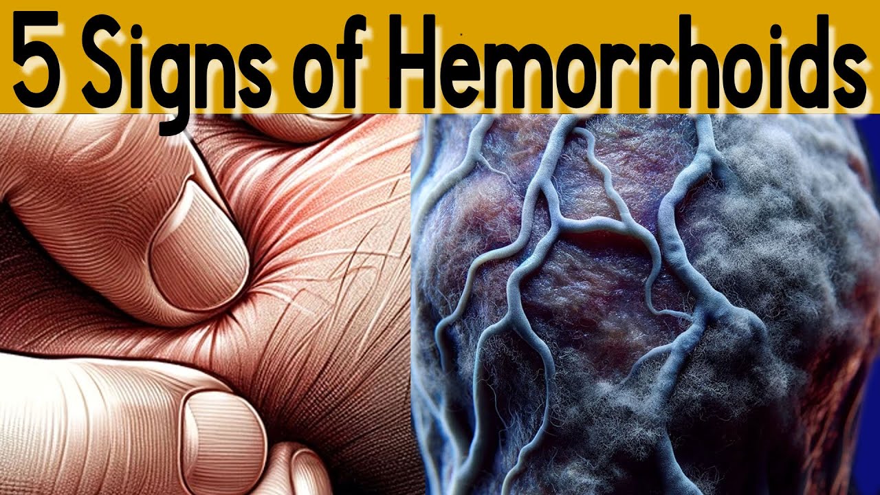 5 signs and symptoms of Hemorrhoids  and treatment