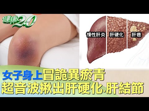 瘀青 長毛