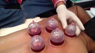 My first Hijama session