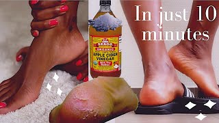 how to remove dead skin from your feet naturally at home 2021| cracked heels home remedy