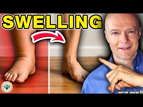 №1 Лучший способ уменьшить отек ног и лодыжек