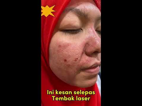 Rawatan parut paling effective dengan awatan PicoHexa Laser . Pertanyaan WhatsApp 016-6701698.