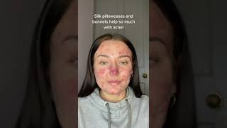 Silk pillowcase is best for acne? #shorts