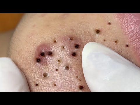 Blackhead Removal * ASMR Relaxation *