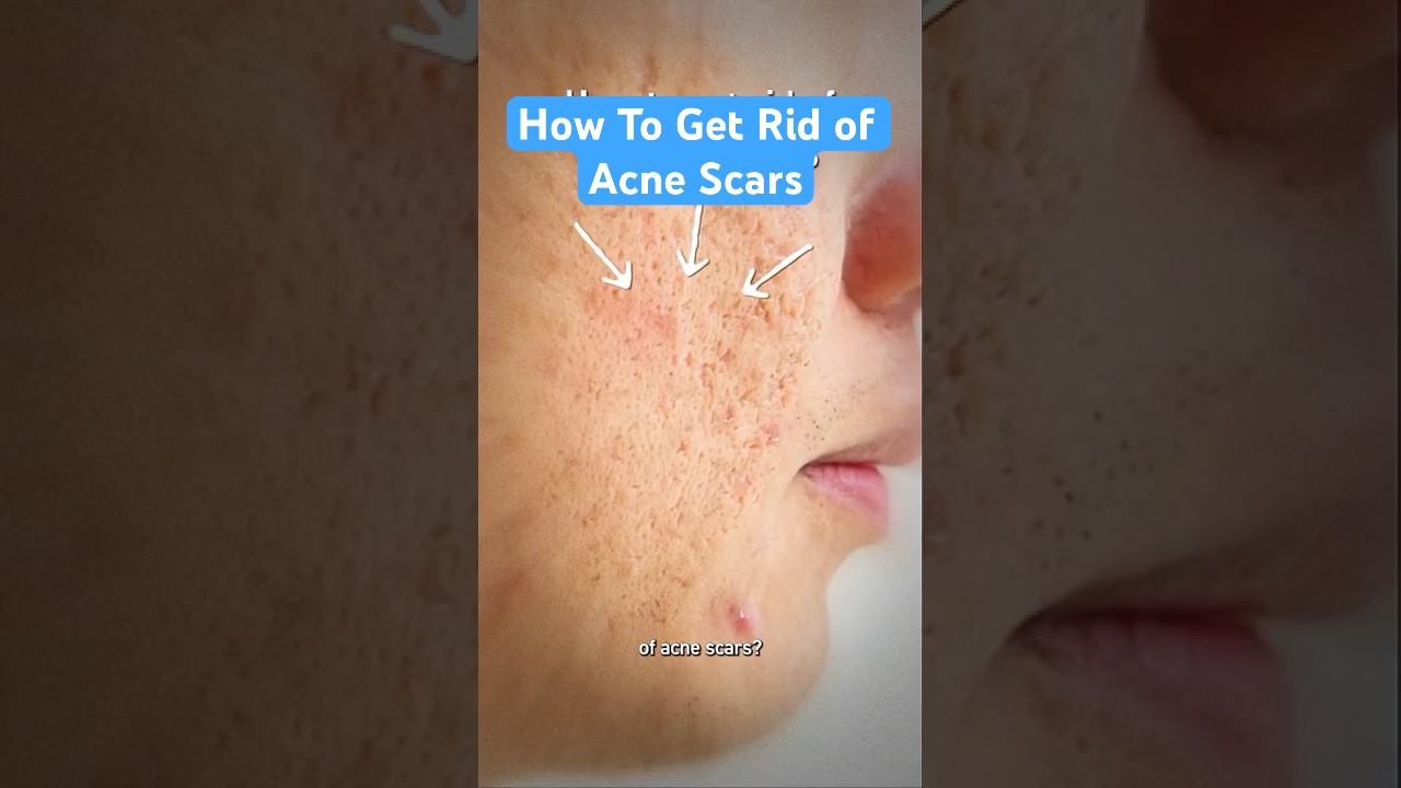 How To Get Rid of Acne Scars