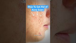 Download lagu How To Get Rid of Acne Scars mp3