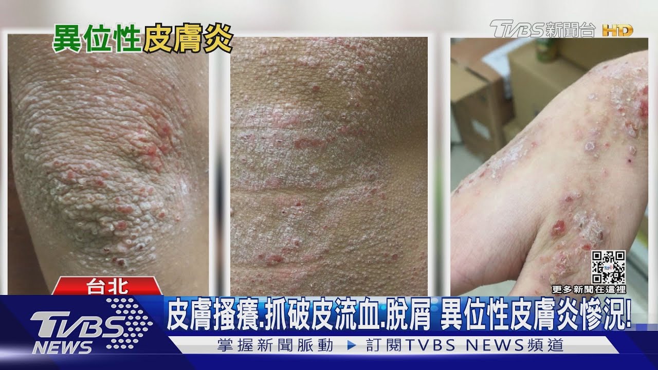 皮膚出現「三大症狀」全身抓流血　搔癢難耐醫警告別做這件事