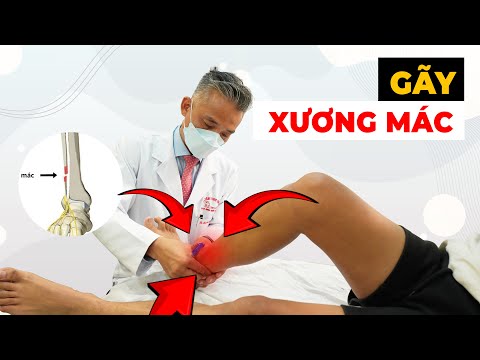 Gãy Xương Mác Khiến Bạn Không Thể Đi Lại? Đây Là Cách Để Phục Hồi Hiệu Quả!