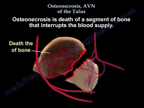 Osteonecrosis, AVN Of The Talus - Everything You Need To Know - Dr. Nabil Ebraheim