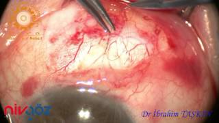 Mitomycin c trabeculectomy and peripheral iridectomy