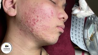 Tratamento para Acne | Muito Satisfatório | Remoção de cravos e espinhas 😍