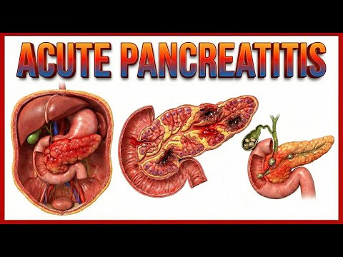 Acute Pancreatitis: Etiology , signs and Symptoms, pathophysiology , Diagnosis, Treatment