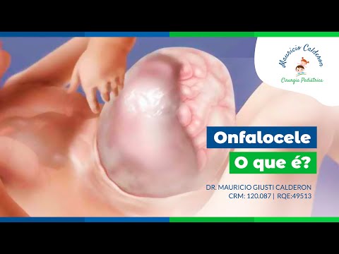 Cirurgia Infantil Channel | Onfalocele, o que é?
