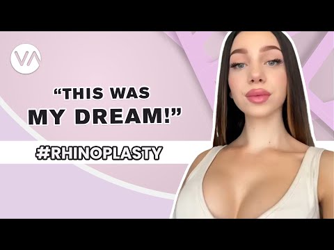 Nose Job Journey | This Was My Dream