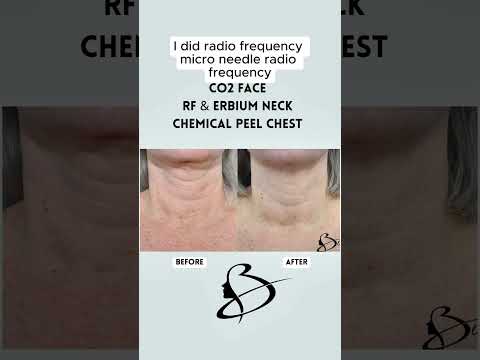 What requires ongoing maintenance after a facelift?  Yes, your face, but don't neglect the neck.