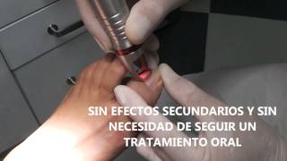 PodoLASER Sevilla - Tratamiento Laser Onicomicosis