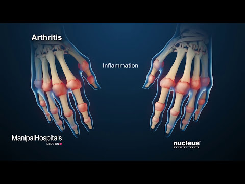 Artrózis tünetei és a kezek kezelése
