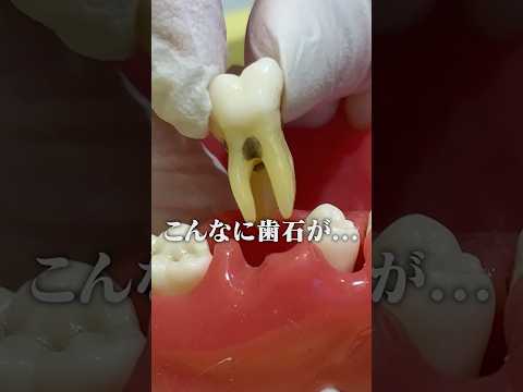 This is dangerous for people who have swollen gums easily!