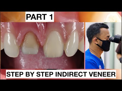 Step by Step 2 Indirect Veneer with Discoloration Tooth. Part 1