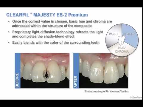Клеарфил Маджести ЕС-2 Премиум, цвет А3E Эмаль, Clearfil Majesty ES-2 Premium (Kuraray) 3.6 г - фото 1 - id-p2139076928
