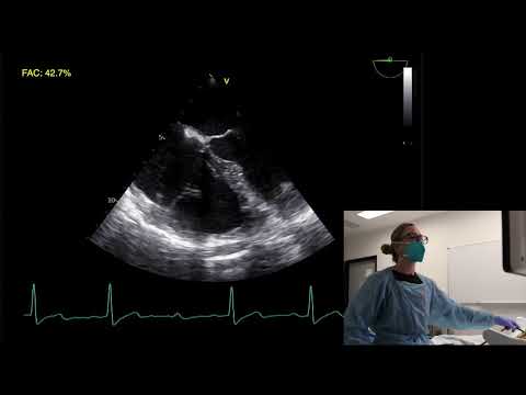 Ep 8: Basic TOE/TEE assessment of the right ventricle