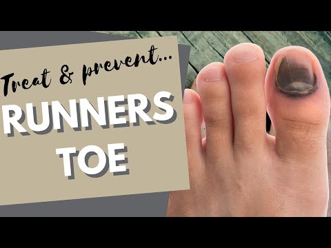 Runners Toe: How to prevent and treat black toenails