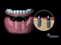 Blue Sky Bio Multi Unit Abutment