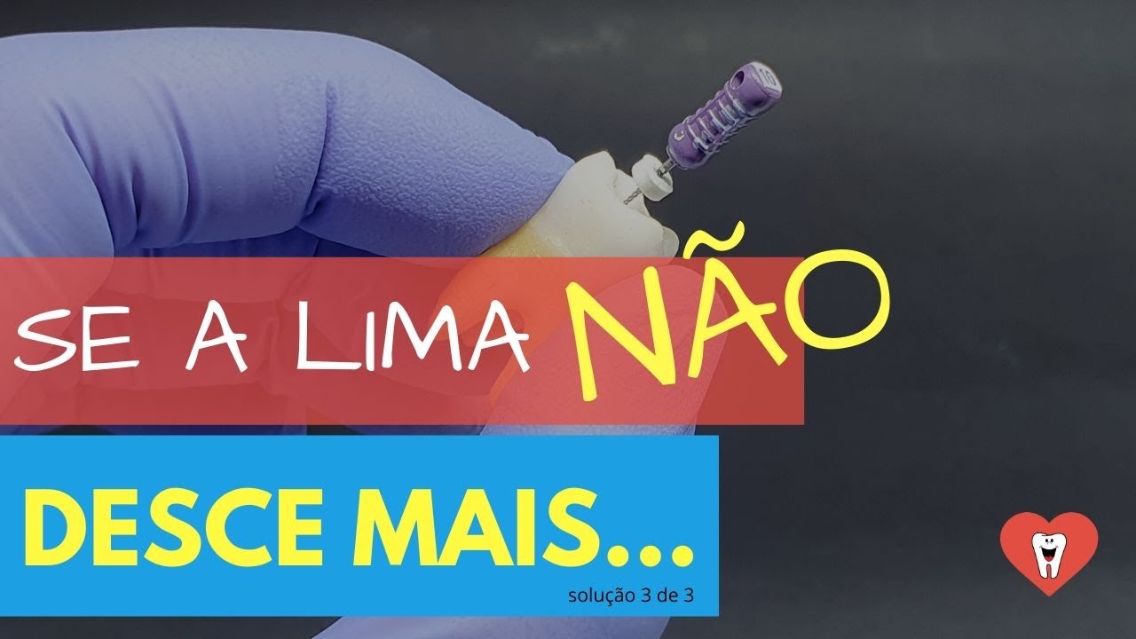 SE A LIMA NÃO DESCE MAIS, O SEGREDO PODE SER ESSA SACADA SIMPLES - ENDOLOVERS QUICK TIP