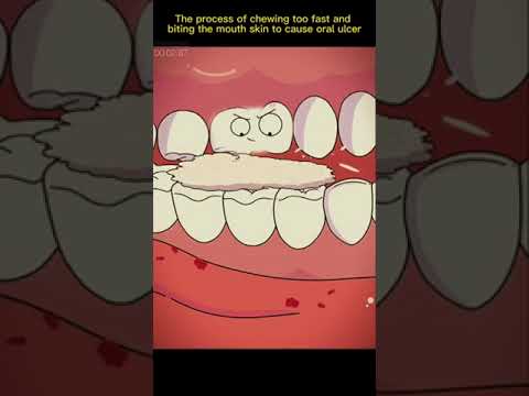 The mouth skin to cause oral ulcer