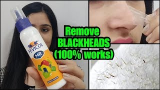 HOW TO REMOVE BLACKHEADS PERMANENTLY - EASY AND PAINLESS METHOD