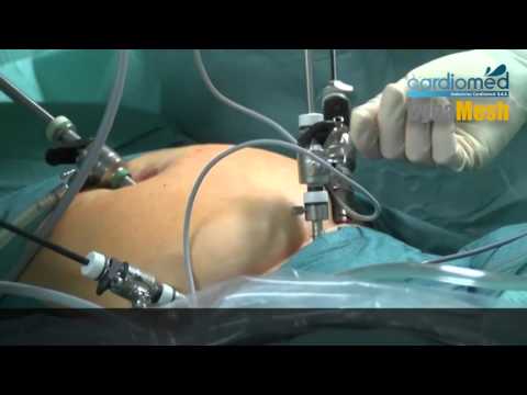 Sacrocolpopexia con Dynamesh PRS