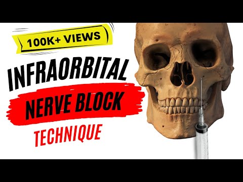 Injection Techniques: Infraorbital nerve block