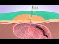 Inserting A PEG Gastric Tube Medical Animation