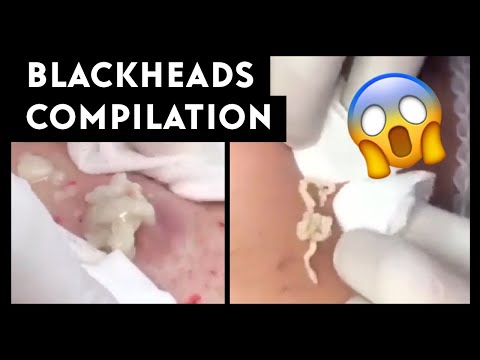 Satisfying Blackheads Compilation 1