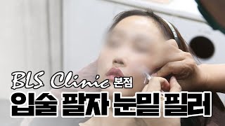 입술, 팔자, 눈밑 필러시술영상 비엘에스의원 본점