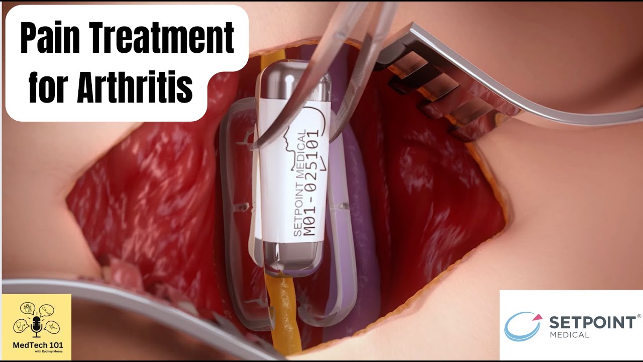 Bioelectronic Medicine: Entering a New Era of Pain Management Without Pills with Dr Kevin Tracey