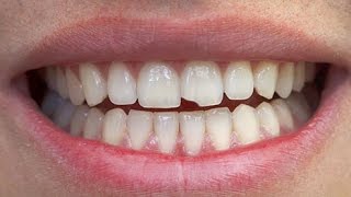 I told you not to run...