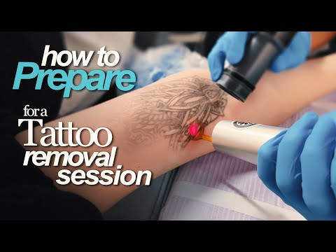 Preparing for Tattoo Removal? Watch This First
