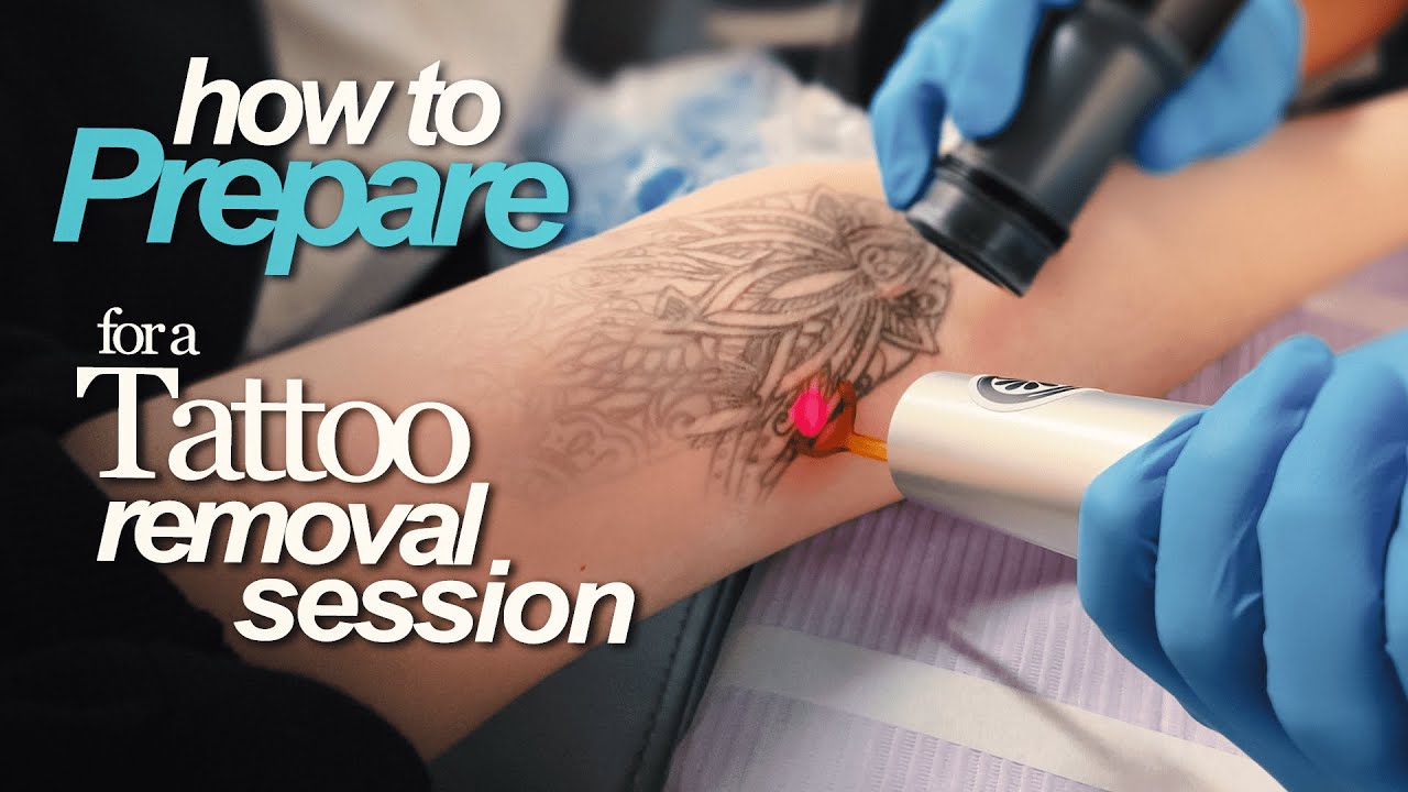 Preparing for Tattoo Removal? Watch This First
