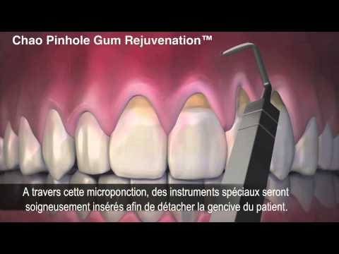 comment traiter une recession gingivale