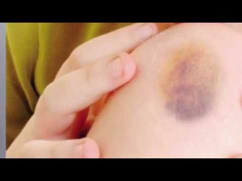 Keni shenja të nxirash në trup edhe kur nuk përplaseni me ndonjë gjë, ç’tregon kjo gjë për ju