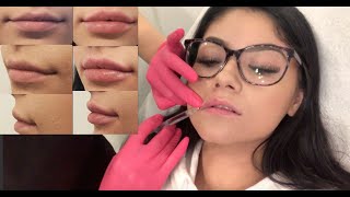 Trying Lip Fillers for the First Time