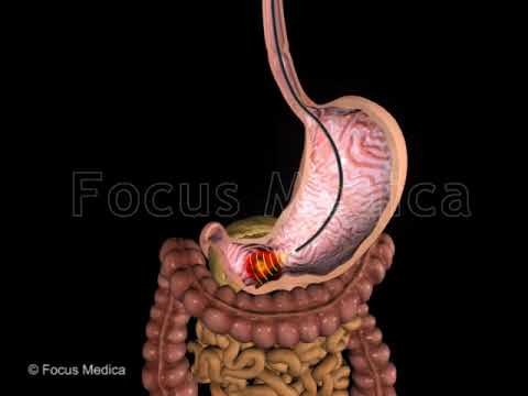 TNM staging of gastric cancer - Animated Atlas of Breast and Gastric Cancer