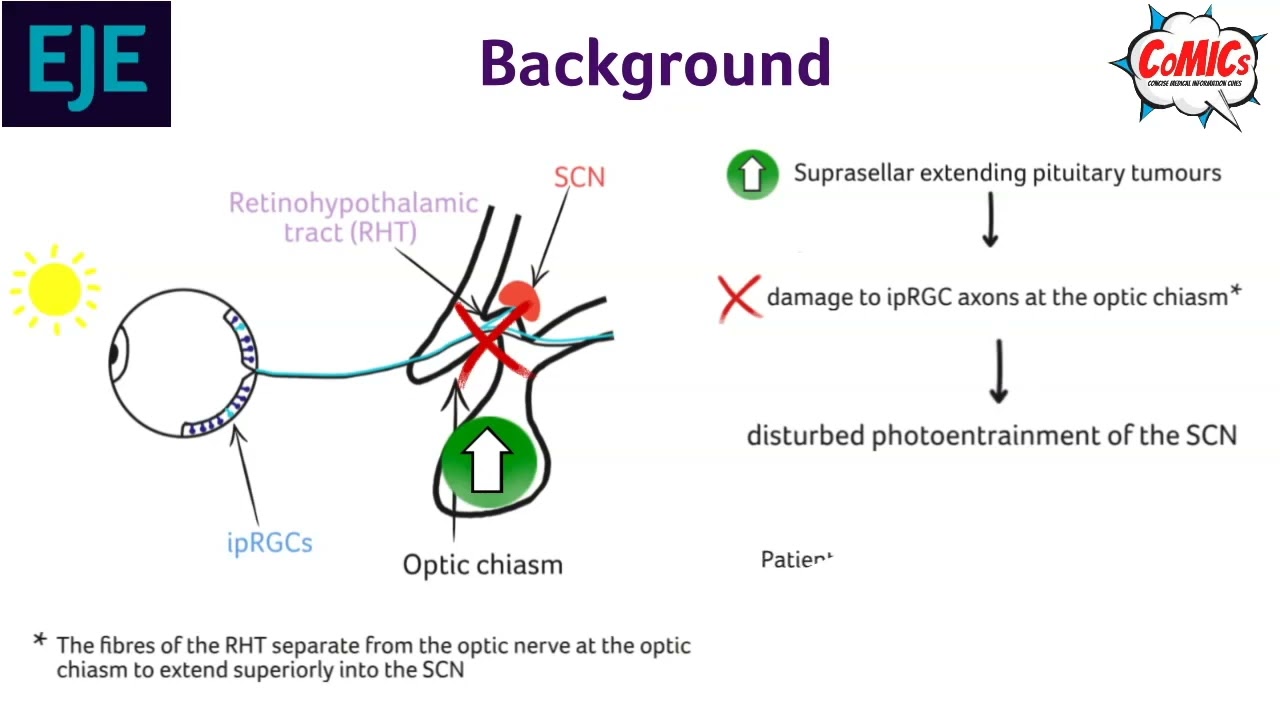 Ep 30: Optic chiasm compression and reduced photoentrainment of the central biological clock.